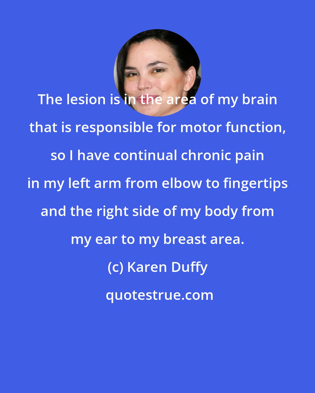 Karen Duffy: The lesion is in the area of my brain that is responsible for motor function, so I have continual chronic pain in my left arm from elbow to fingertips and the right side of my body from my ear to my breast area.