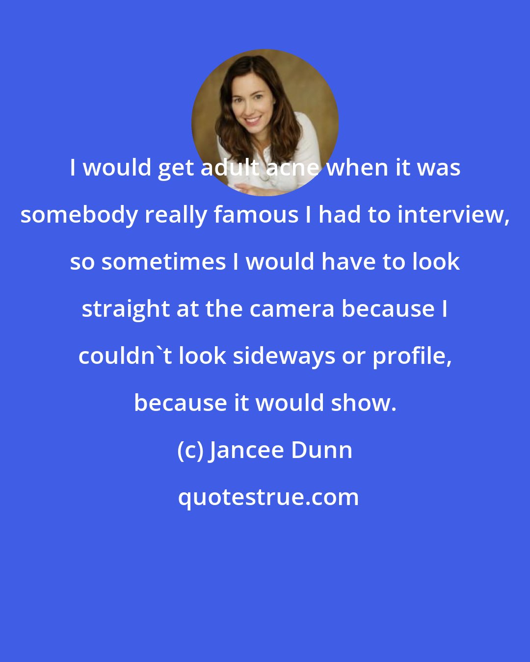 Jancee Dunn: I would get adult acne when it was somebody really famous I had to interview, so sometimes I would have to look straight at the camera because I couldn't look sideways or profile, because it would show.